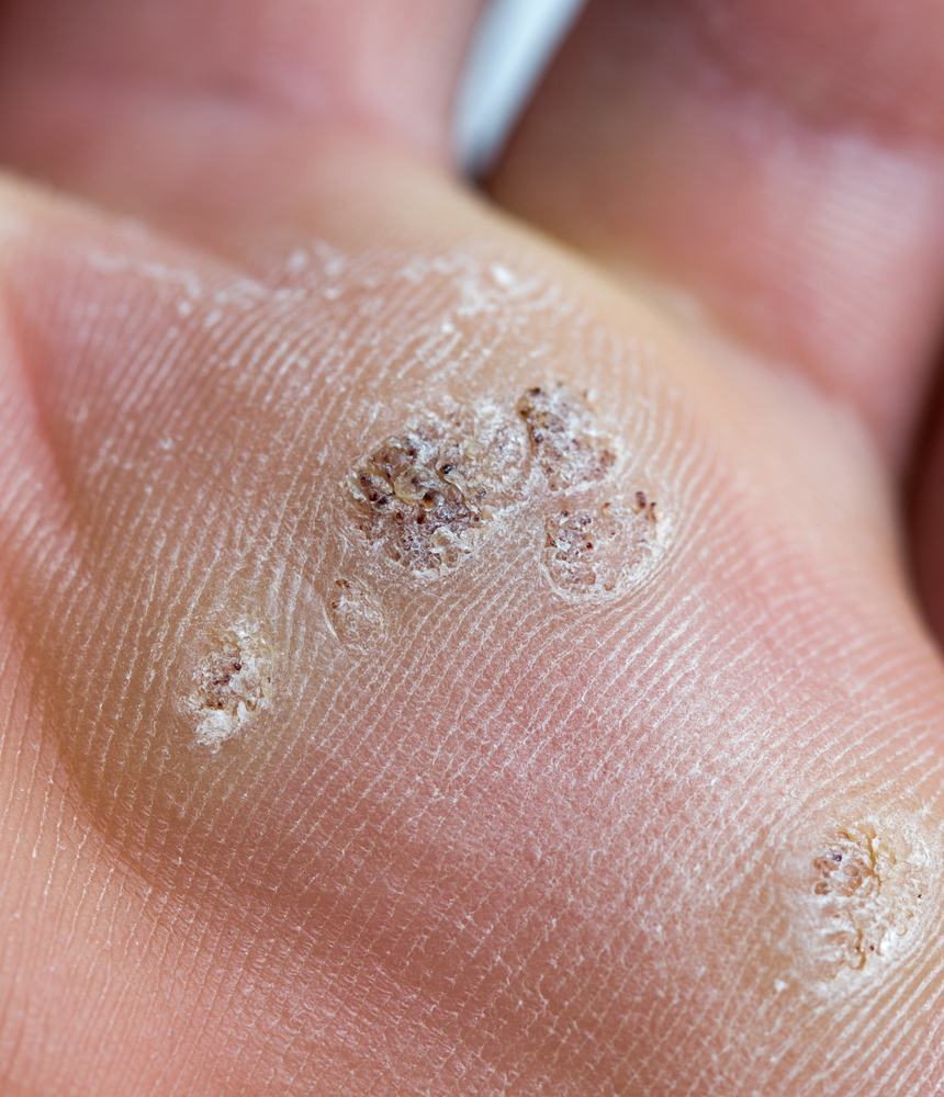 Μυρμηγκιές / Κονδυλώματα 10 Myrminkies Kondylomata