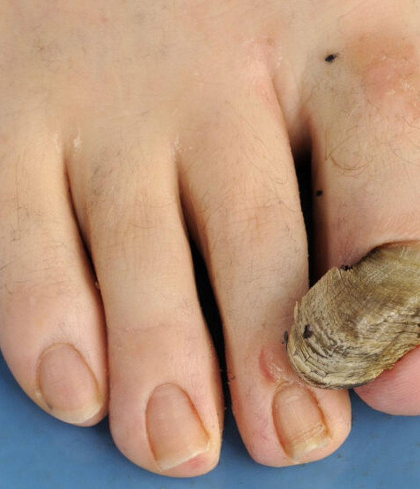 Ονυχογρύπωση 17 Onychogryposi