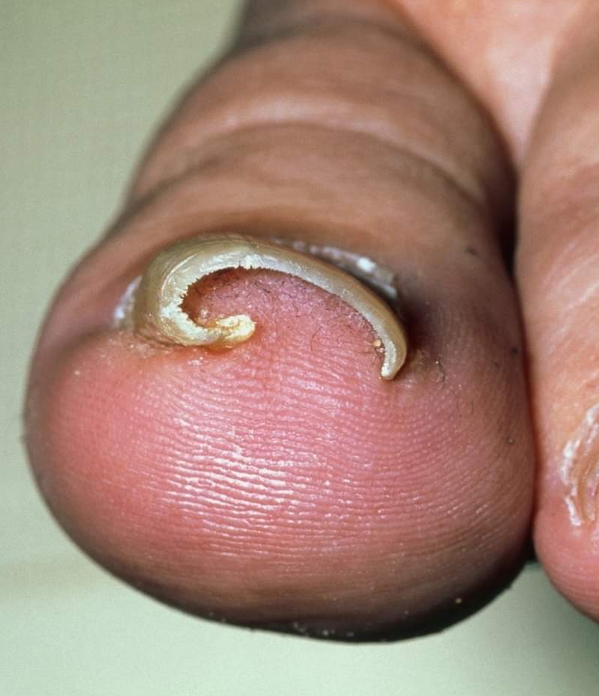 Ονυχοκρύπτωση 16 Onychokryptosi