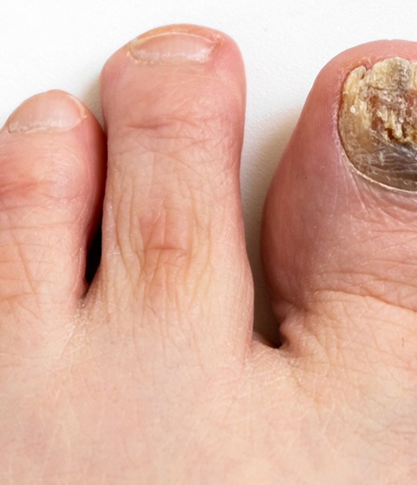 Ονυχομυκητίαση 13 Onychomykitiasi