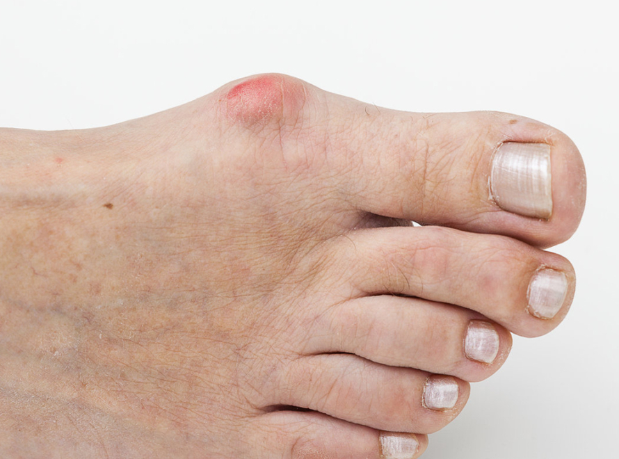 Πώς να Διαχειριστείτε και να Προλάβετε το Κότσι (Bunion) 26 bunion