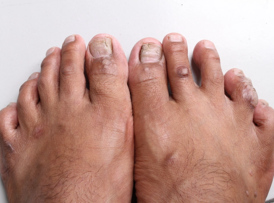 Διαβητικό Πόδι: Τι Πρέπει να Γνωρίζετε 21 diabetic feet