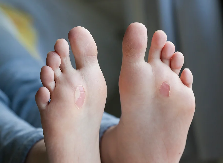 Φυσαλίδες στα Πόδια: Αιτίες, Φροντίδα και Πρόληψη 22 foot blisters